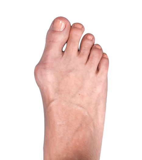 Yes, bunions can cause pain in other parts of the foot, such as the arch, toes, and ball of the foot, due to altered foot mechanics and pressure.