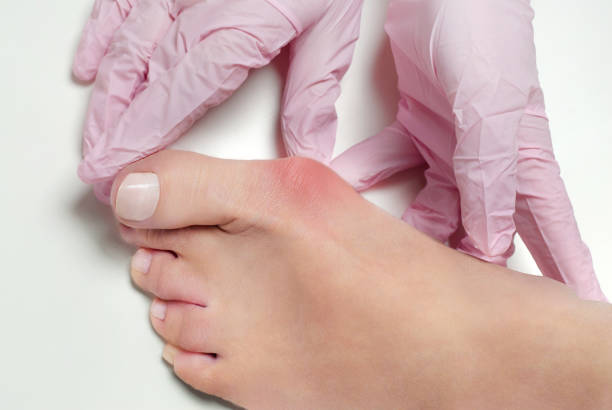 Bunion surgery recovery typically takes 6–12 weeks. Complications may include infection, stiffness, swelling, and in rare cases, nerve damage or recurrence.