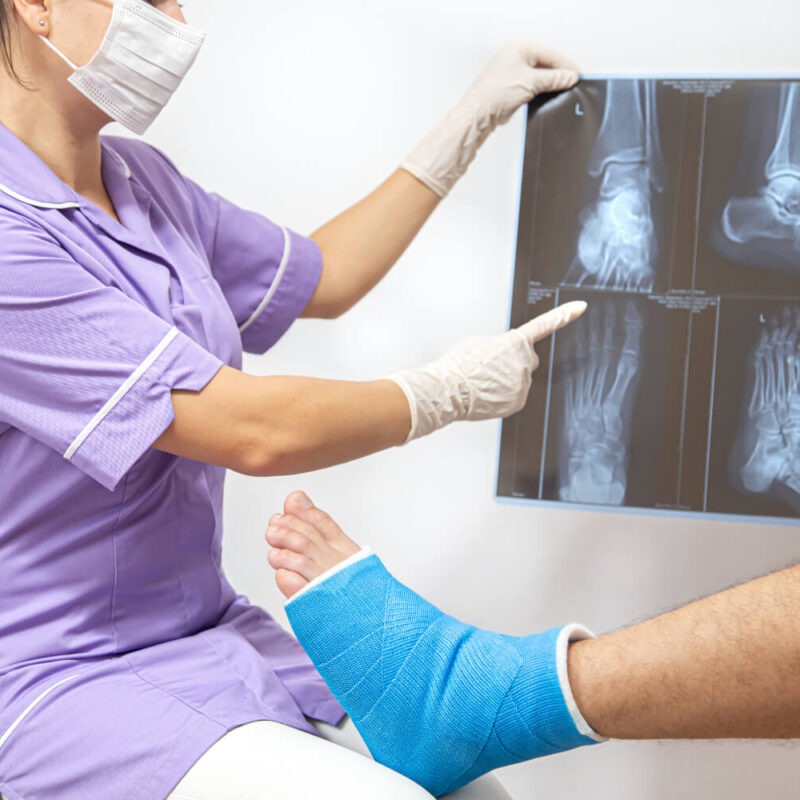 For expert non-displaced ankle fracture surgery in New Jersey, call New Jersey Foot Surgeons at (732)-320-9173 to book your appointment today!